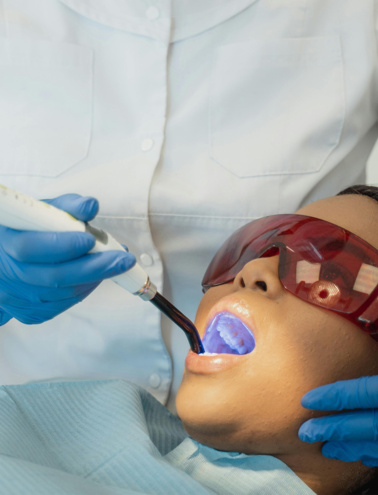 Composite Fillings